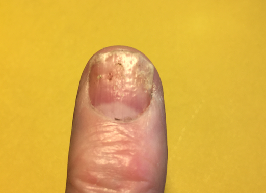 Fix a broken fingernail | Fix broken nail, Cracked nails, Fix cracked nail